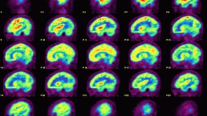 California Doctors Hope To ‘Rewire' Depressed People's Brains