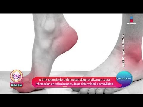 ¿Qué es y cómo se ocasiona la artritis reumatoide? | Sale el Sol