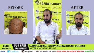 Hair Transplant Review after 3 months - FUE 4500 Grafts at FCHTC clinic Ludhiana