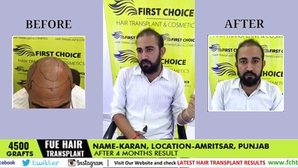 Hair Transplant Review after 3 months - FUE 4500 Grafts at FCHTC clinic Ludhiana