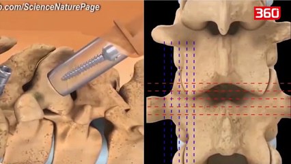 Si te drejtoni nje shpine te shtrember (360video)