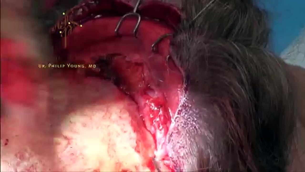 Warning Graphic: Brow Lift With Muscle Excision Live Plastic Surgery Video By Seattle's Dr. Young