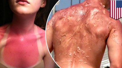 This is why it’s a bad idea to have fun in the sun without sunscreen