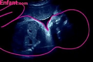 Voyage in utero - le 9e mois