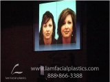FACE LIFT ALTERNATIVE WITH FAT GRAFTING IN ST.LOUIS PART 3
