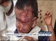 أمراض جلدية غريبة تهاجم النازحين اليمنيين
