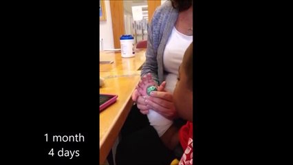 Primer trasplante de manos en un niño es un éxito