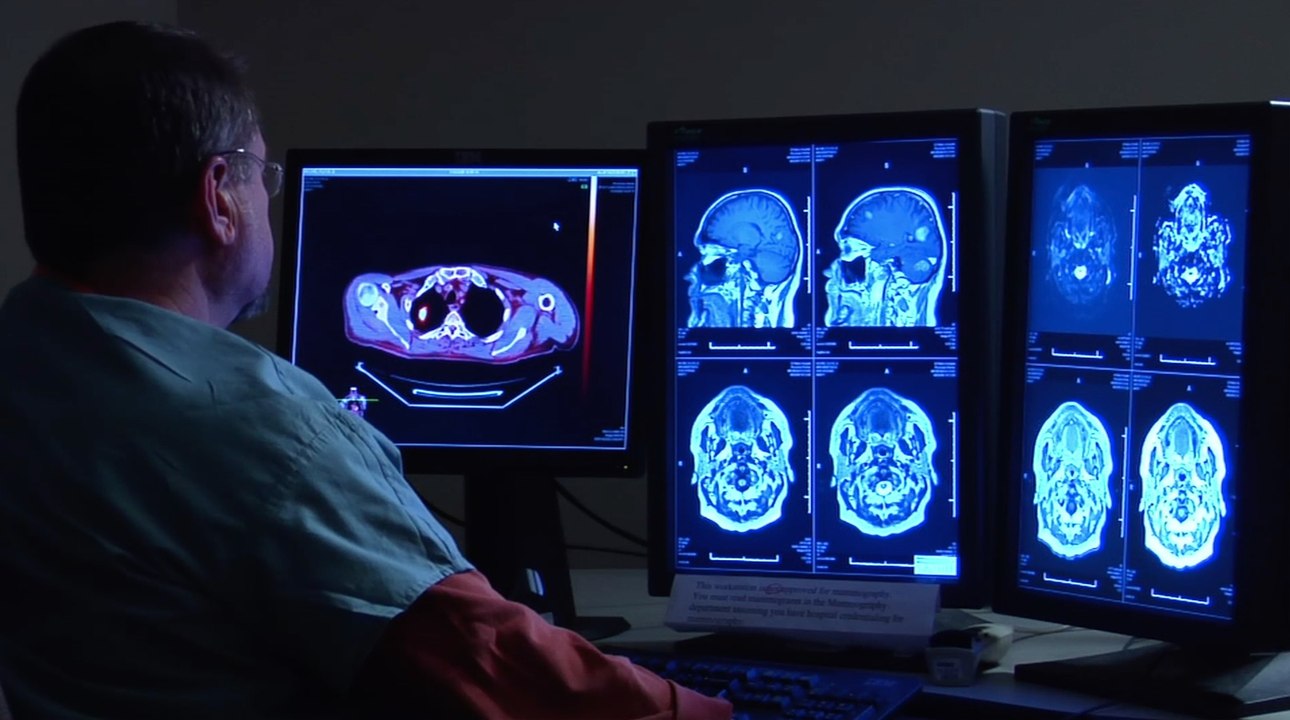 What is glioblastoma?