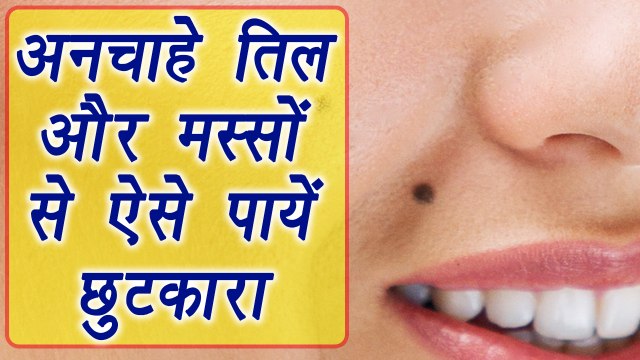 तिल, मस्सों से छुटकारा पाने के घरेलू उपाय, How to get rid of Mole & Warts | Home Remedies | Boldsky