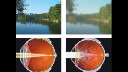 ד"ר יעקב גולדיץ' - ניתוח קטרקט