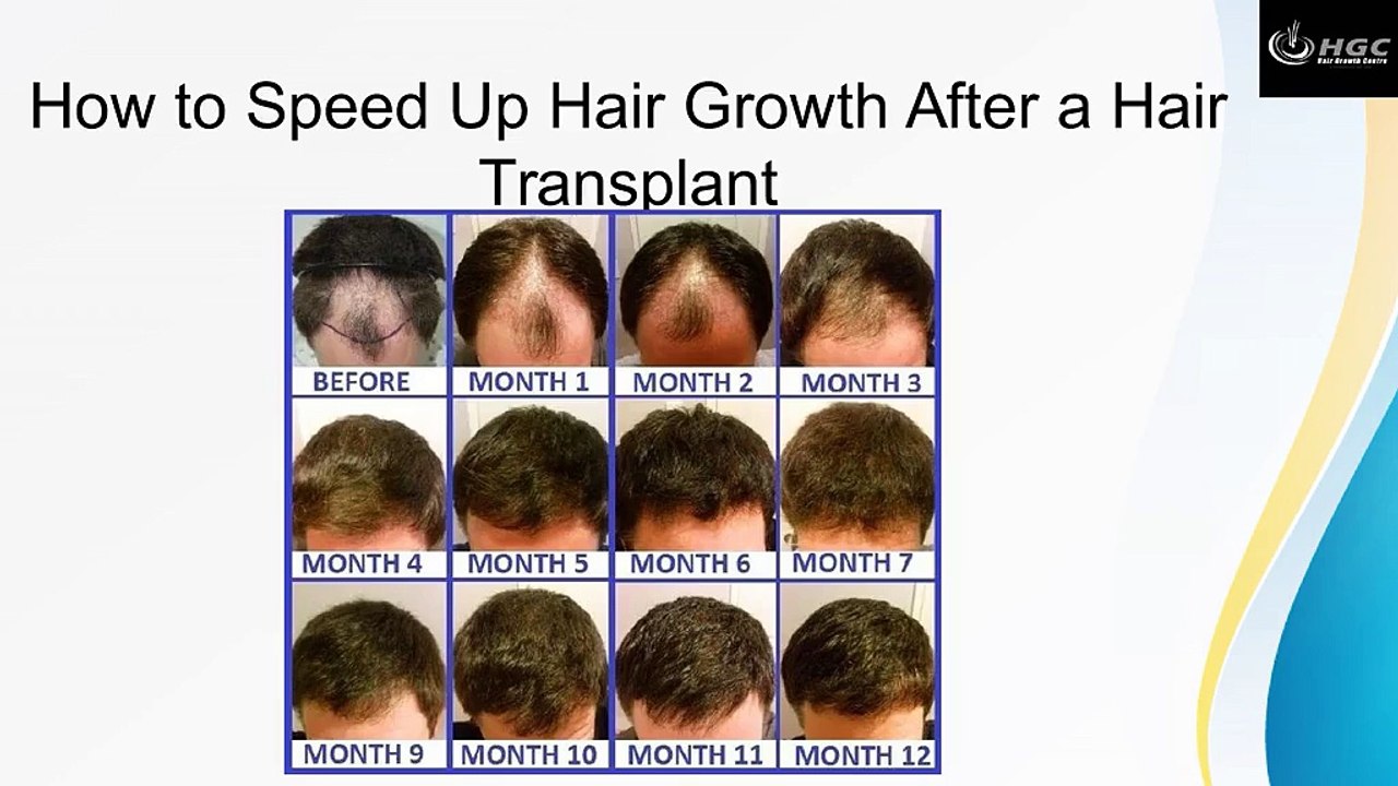 How to Speed Up Hair Growth After a Hair Transplant