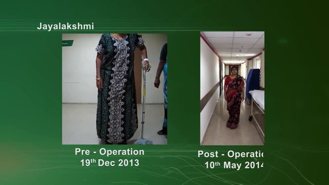 Successful Knee Replacement 2017, Total Knee Replacement Surgery Result Everyone Must Watch )