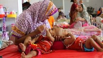 Médicos de Bangladesh evalúan posible cirugía de siamesas unidas por cabeza