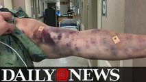 Mystery bug leaves Arizona man covered in bruises
