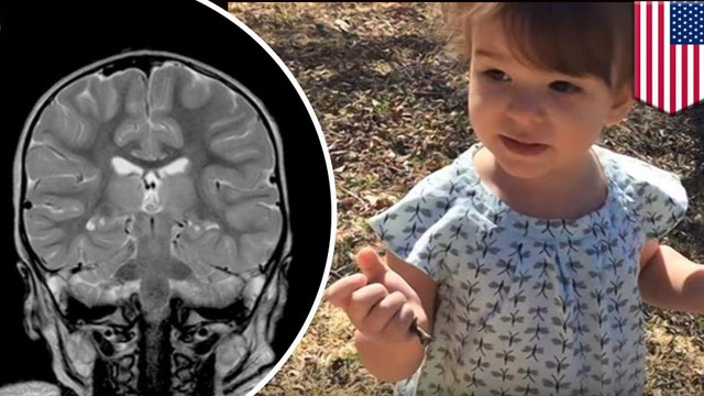 Toddler's brain damage reversed using oxygen treatments