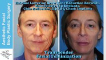 Transgender Facial Feminization FFS, MTF, M2F Plastic Surgery Video by Seattle Bellevue's Dr. Young