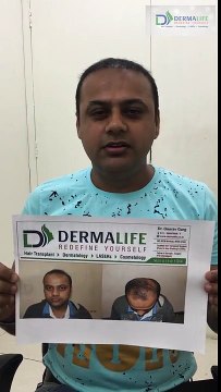 DermaLife Skin Care & Hair Transplant Clinic results after Hair Transplant 10