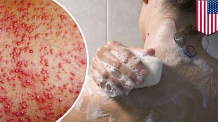 Preservatives in bath products could be causing eczema