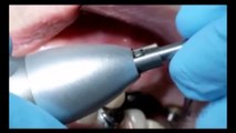 Как снимают коронку зуба? Проект с блогером