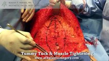 Tummy Tuck Lift Procedure & Live Surgery - Plastic Surgery Video by Doctor Parikh. Warning Graphic!