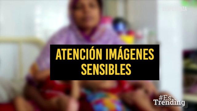Científicos quieren separar a estas siamesas unidas por la cabeza para darles una mejor calidad de vida