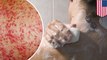 Gatal-gatal karena sabun; bahan pengawet pada produk mandi ternyata berbahaya - TomoNews