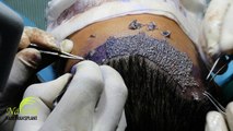 Hair Transplant in Delhi - Hair Graft Implantation during FUE Surgery - Natural Hair Transplant