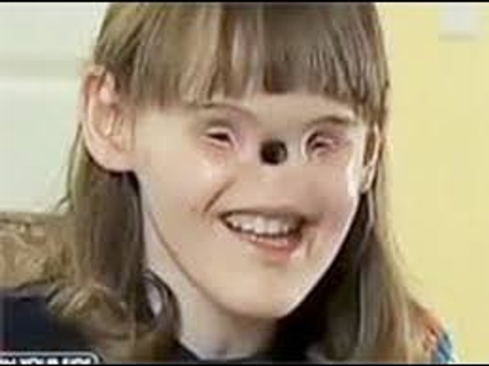 Girl Born with NO Nose and Eyes __ MUST WATCH