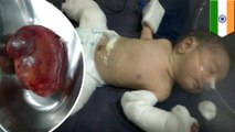 Fetus in fetu: Baby boy in India born carrying parasitic twin brother in abdomen