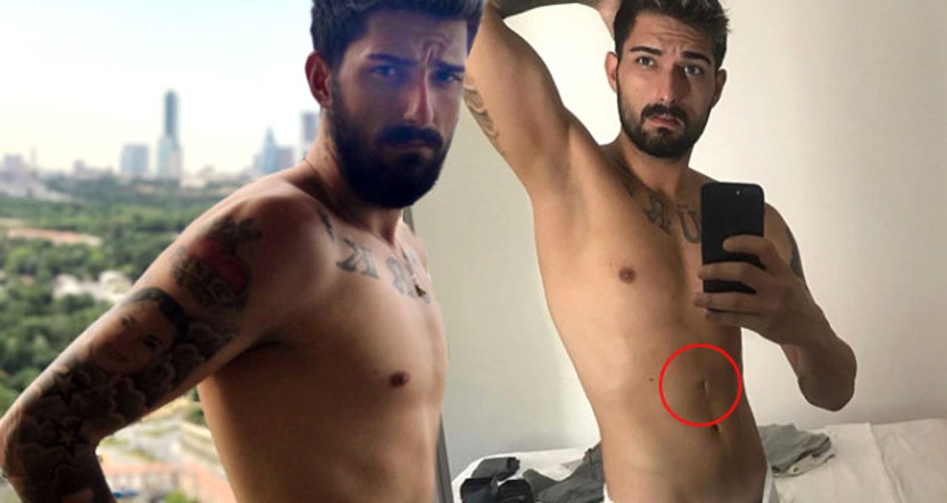 İdo'nun Midesindeki İzi Babası Açıkladı: Mide Borusu Doğuştan Tıkalıydı