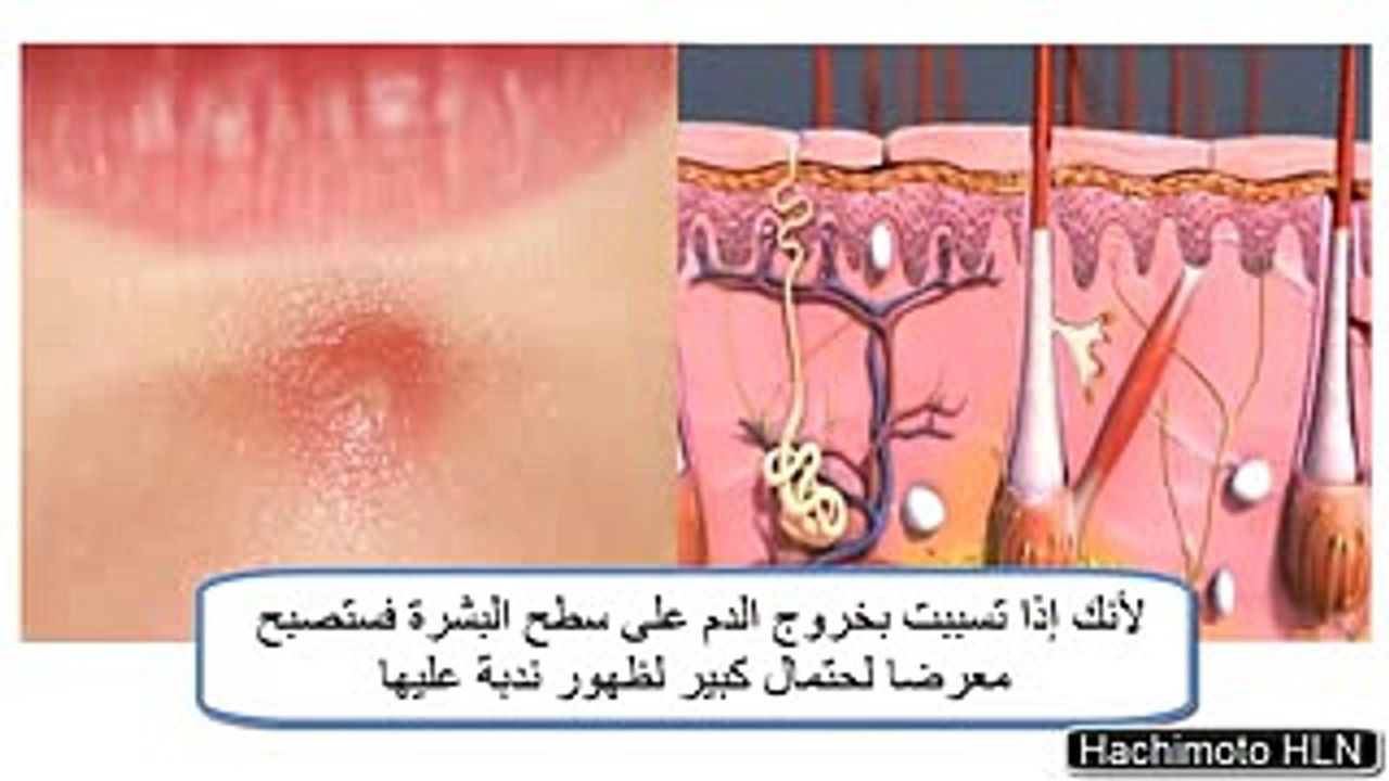 الطريقة الصحيحة و المثالية للتخلص من محتوى حبوب الوجه و الرؤوس السوداء و البيضاء - YouTube