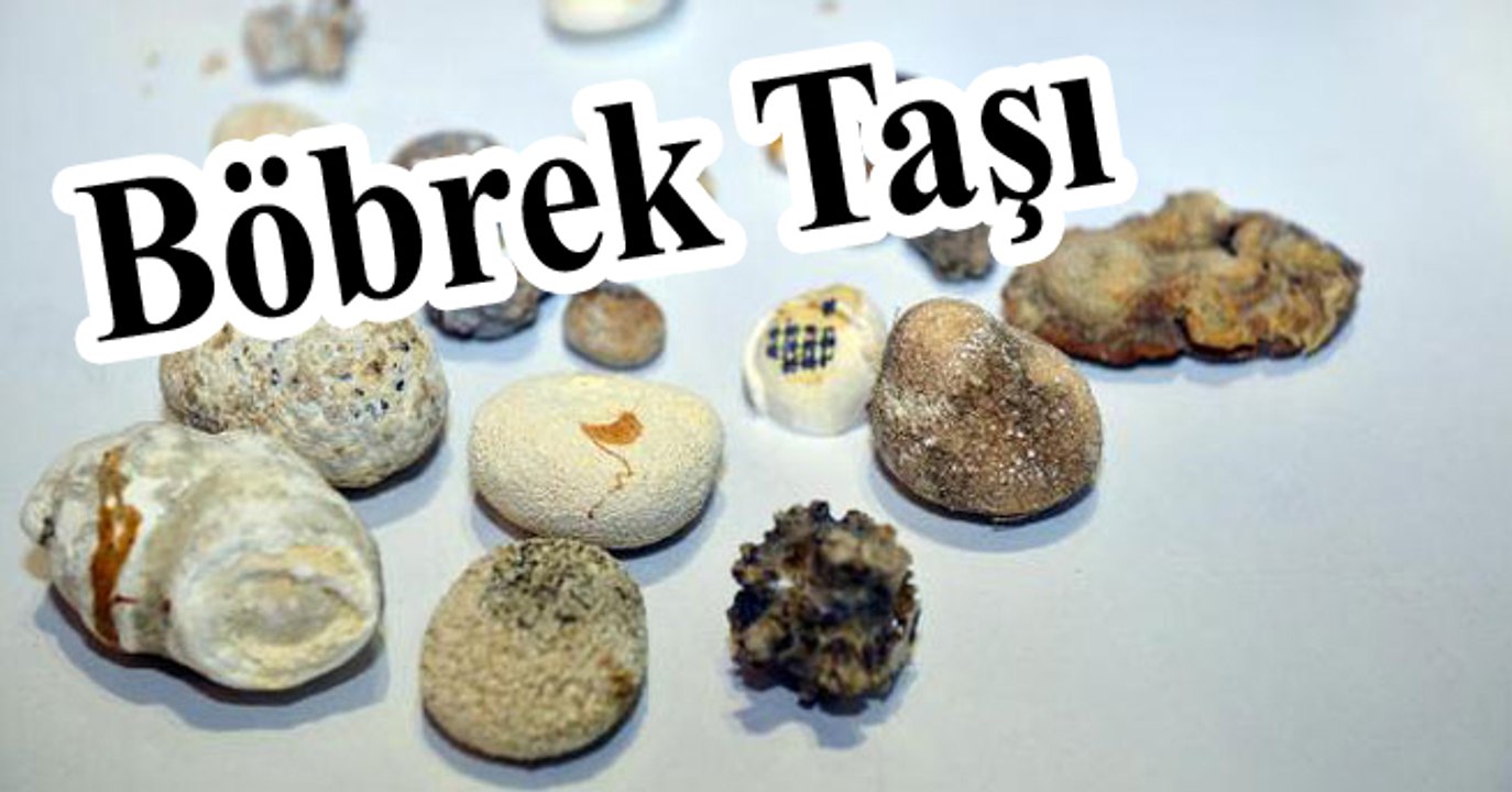 Böbrek Taşı Nasıl Oluşur? Böbrek Taşı Belirtileri Nelerdir? | İşte Bilinmeyenler