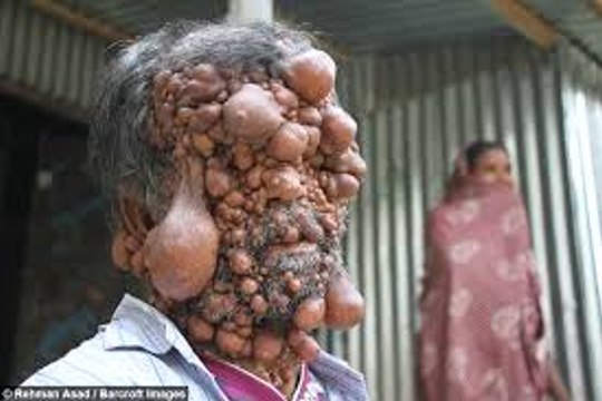 Dad’s Entire Body Is Covered In Tumours