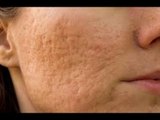 ¿Cómo prevenir las cicatrices del acné?