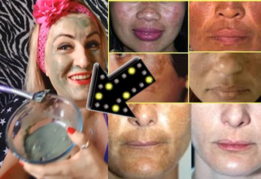 MELASMA como tratar, BASTA uma aplicação E ADEUS MANCHAS,MELASMA,RUGAS receita caseira potente
