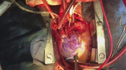 Se realiza el primer trasplante de corazón a manos de una cirujana en México