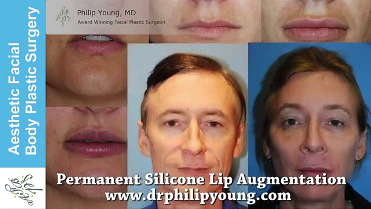 Warning Graphic: Permanent Silicone Lip Augmentation Live Video Demo
