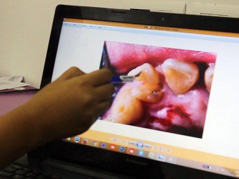 Dental Health - Contraindications of Root Canal Treatment By Dr Richa (Dentist) JJIMS