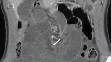 Dental Braces Wire Is Found Twisting Woman’s Intestines a Decade Later