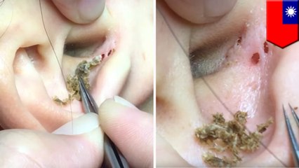 Try and look away from this gross blackhead extraction video