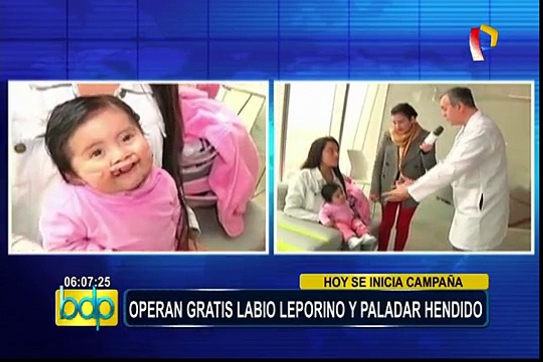 Misión Caritas Felices: operaciones gratuitas a niños con labio leporino y paladar hendido