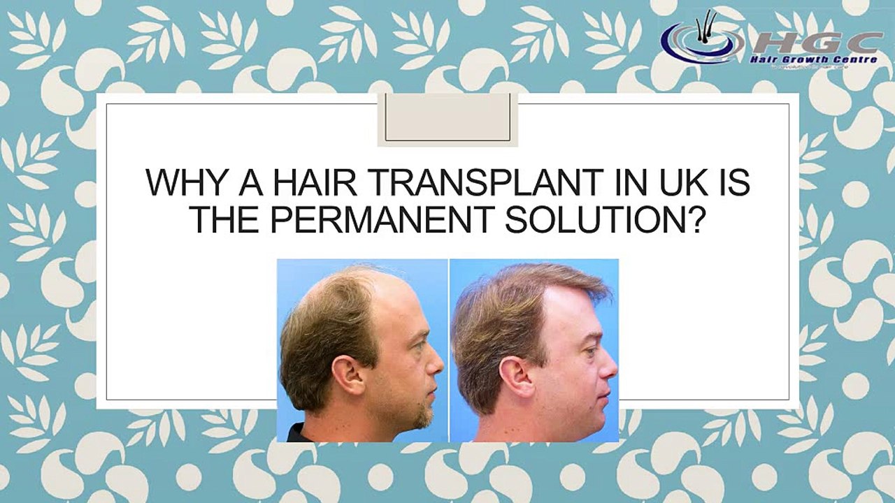 Why A Hair Transplant In UK Is The Permanent Solution