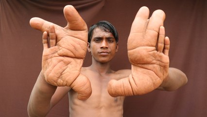 The Boy With The Giant Hands: BORN DIFFERENT