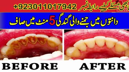 Dental Plaque Homemade Treatment In Just 5 Minutes | Teeth Whitening Tips In Urdu/Hindi