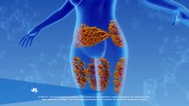 What is the CoolSculpting Treatment
