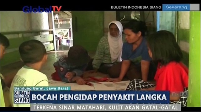 Bocah Ini Gatal-Gatal Jika Kena Sinar Matahari