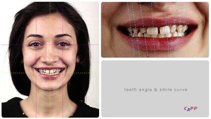 Yes! You can have perfect teeth too!