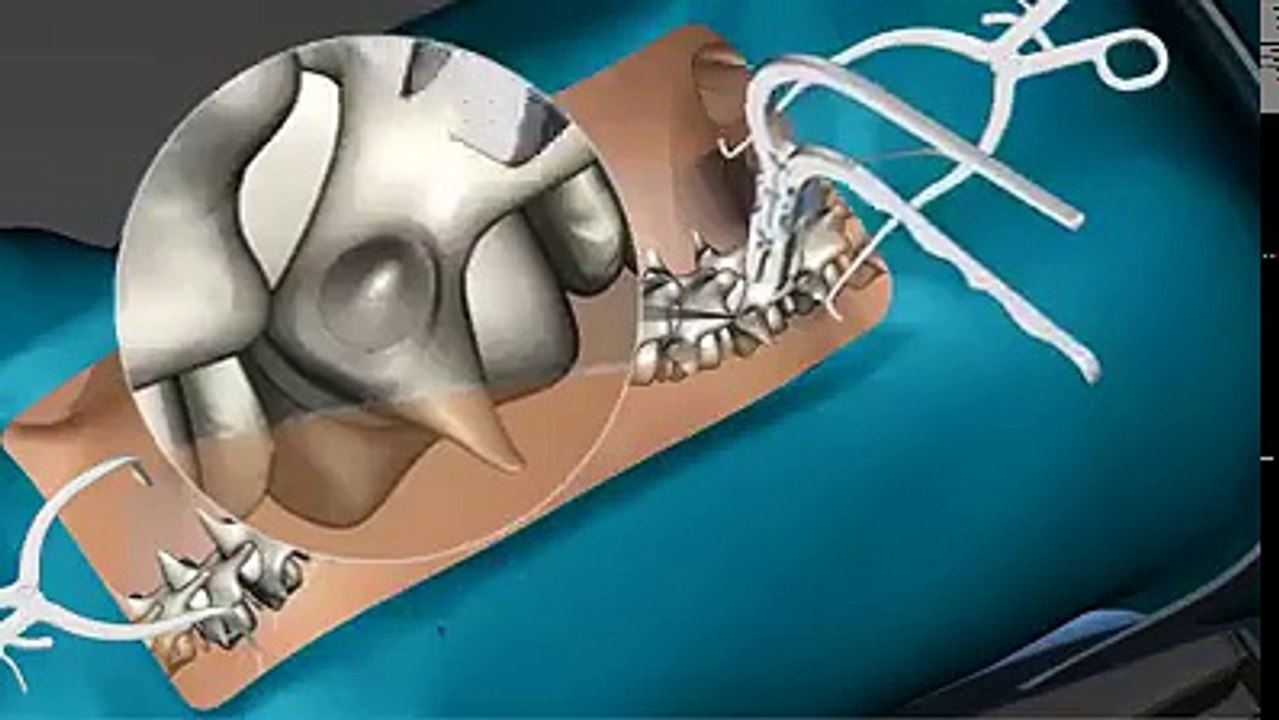 "سبحان الله علم الأنسان ما لم يعلم" عملية تعديل اعوجاج العمود الفقري      Spinal cord twisting
