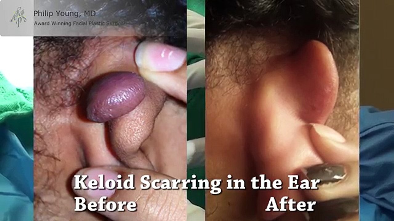 Otoplasty Revision Surgery for Prominent Ears & Congenital Defects by Seattle Bellevue's Dr. Young
