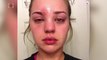 Woman's Terrifying Story Will Have You Thinking Twice Before You Pop a Pimple